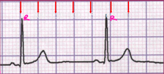 <p><strong>Determining Heart Rate with a Normal Rhythm </strong></p><p>-# of large boxes between RR cycles: ____/# of large boxes between R waves</p><p>-# of small boxes between RR cycles: ____/# of small boxes between R waves</p>