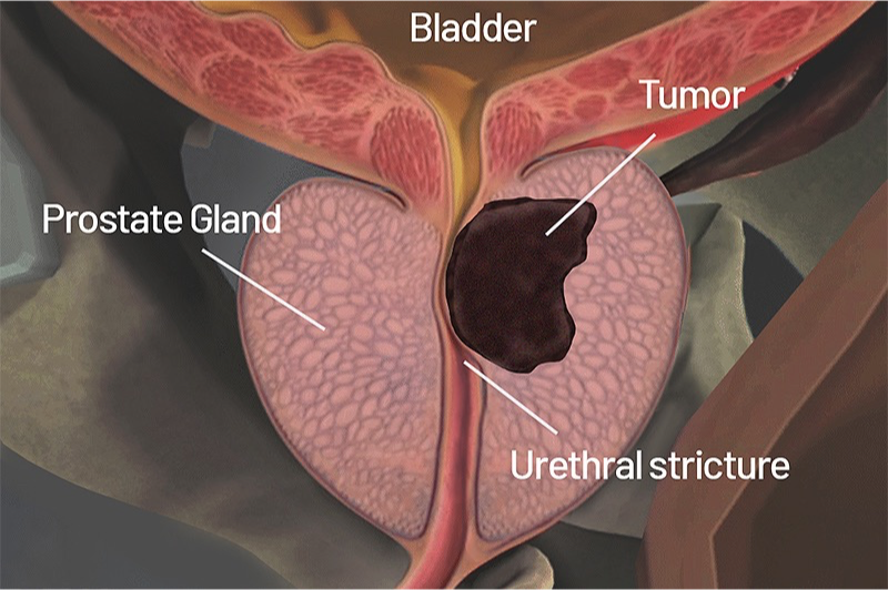 <p>Cancer of the prostate</p>