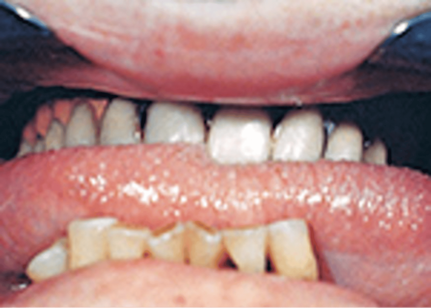 <p>Enlarged tongue; associated with acromegaly</p>