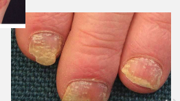 <p><strong>Pitting</strong><span> and </span><strong>yellow-brown discoloration.</strong></p>