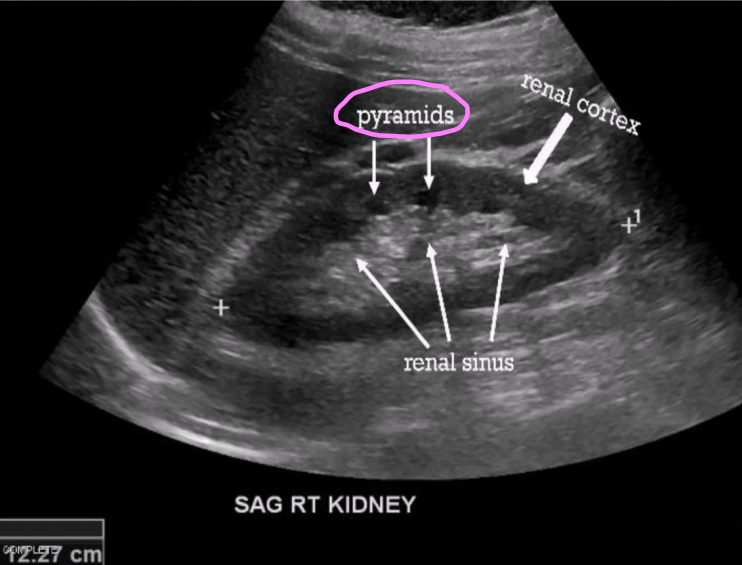 <ul><li><p>Contains 12–18 renal pyramids (triangular shaped)</p><ul><li><p>Carry urine from cortex to renal pelvis </p></li><li><p>Lower echogenicity than cortex</p></li></ul></li></ul><p></p>