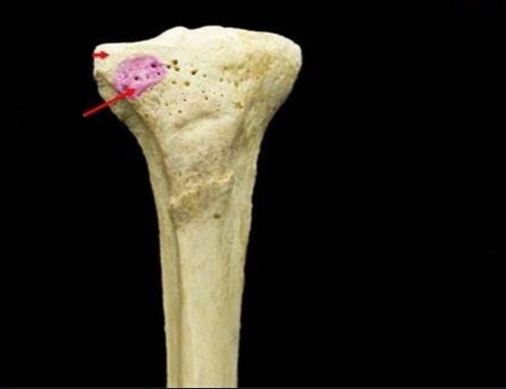 <p>A bony prominence on the lateral aspect of the tibia that serves as an attachment point for the iliotibial band. </p><p>insertion: iliotibial tract (band)</p>