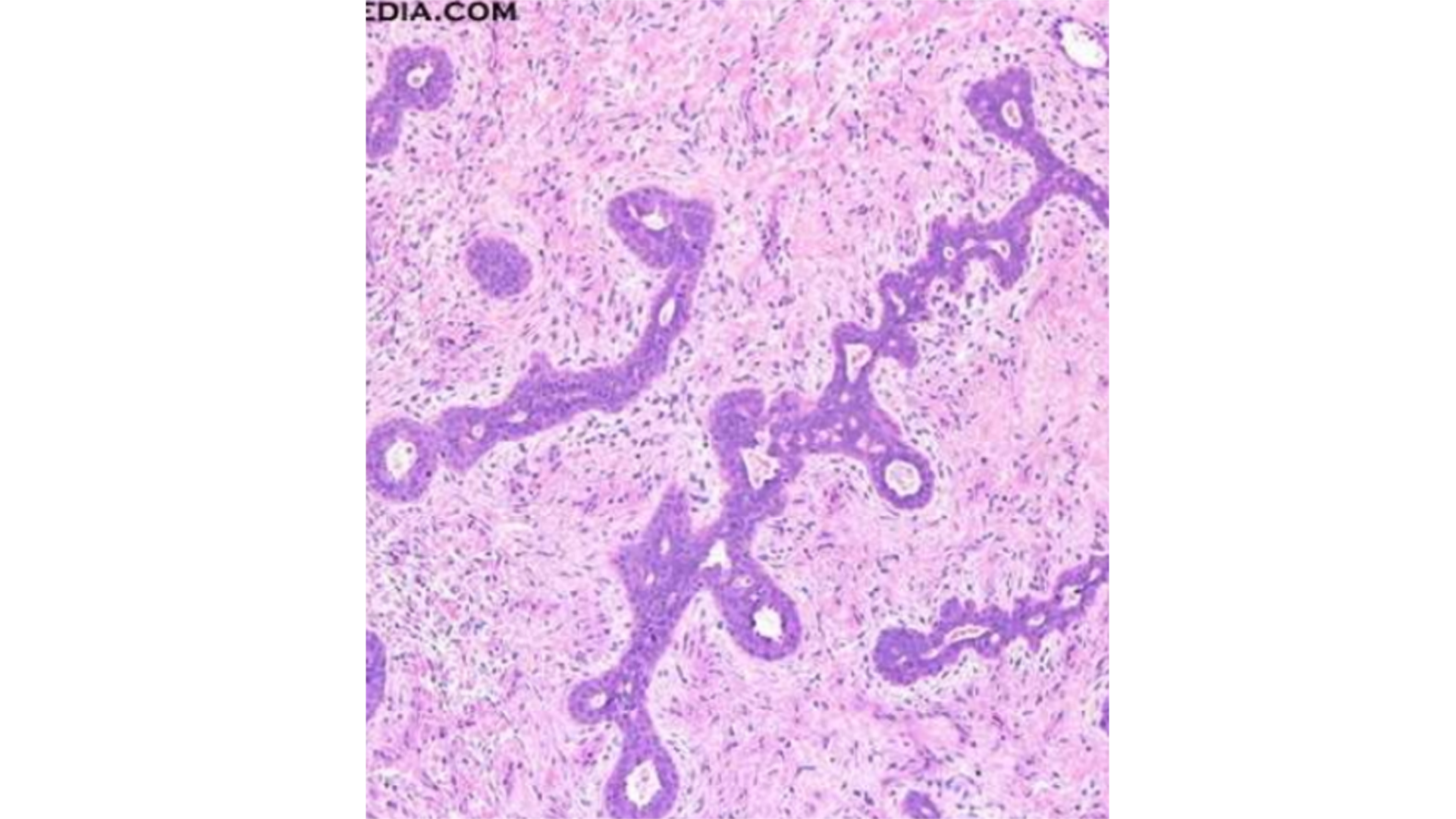 <p>Fibroadenoma of Breast</p>