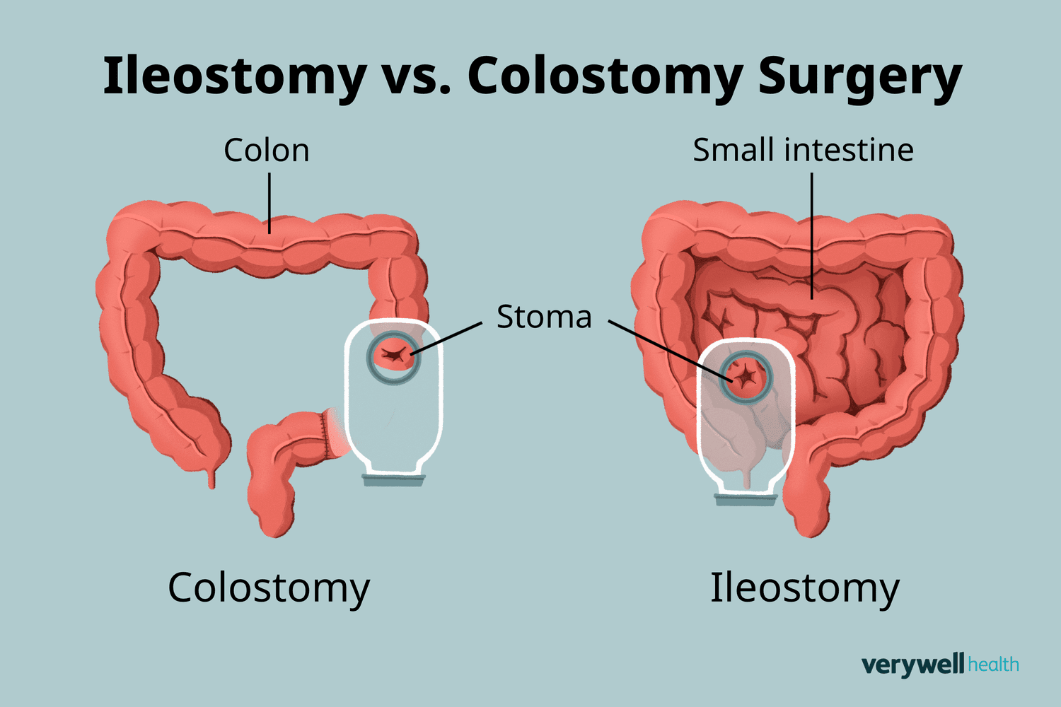 <p>An ileostomy is a surgical opening in the abdominal wall where the end of the small intestine (ileum) is brought to the surface to allow stool to pass into an external pouch.</p>