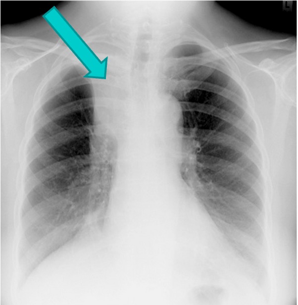 <ul><li><p>This occurs due to obstruction of supplying bronchus by aspirated foreign body or any other material,</p></li></ul><p><strong>Types:</strong></p><ul><li><p>Partial Collapse (Atelectasis)</p></li><li><p>Complete collape</p></li></ul><p><strong>Radiological Appearance</strong></p><ul><li><p>increased brightness</p></li><li><p>Tracheal deviation</p></li></ul><p></p>