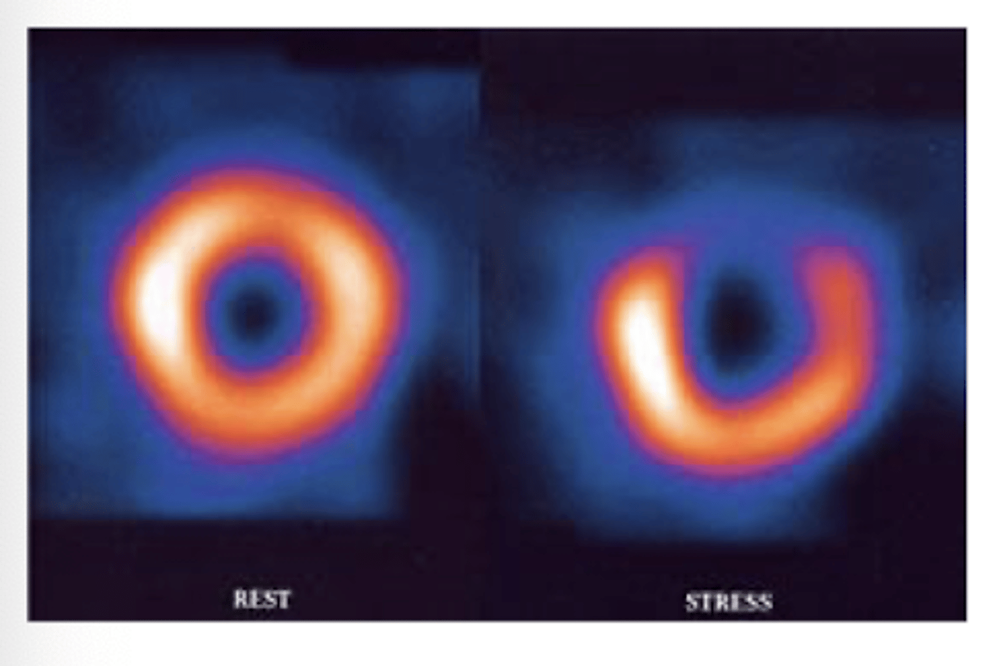 <p>#1 test for evaluating stress --&gt;.R image indicates void of uptake and dec blood supply</p>