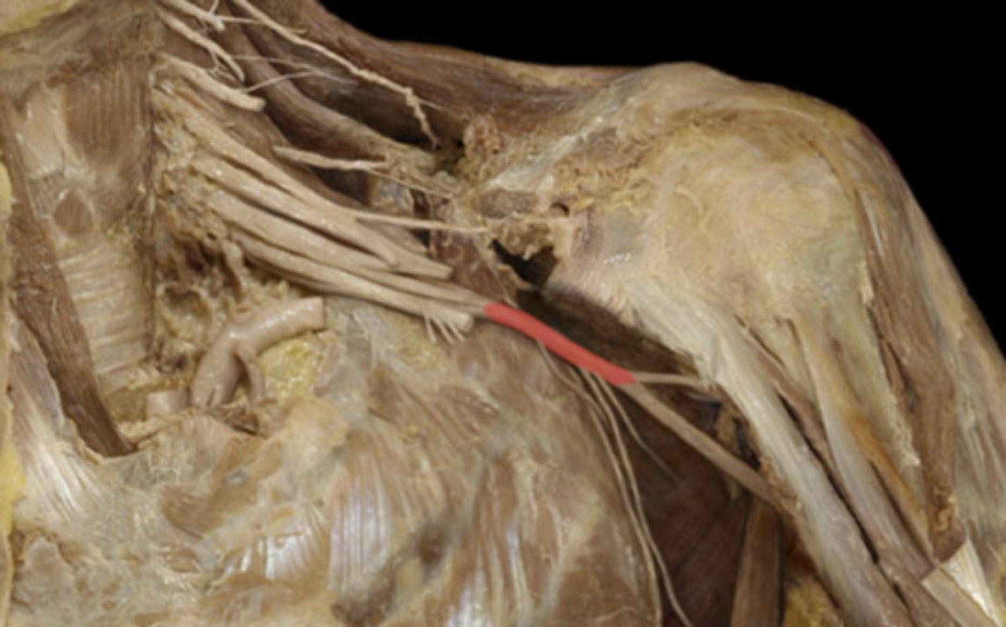 <p>formed by the posterior cord divisions of the upper, middle, and lower trunks; C5-T1</p>