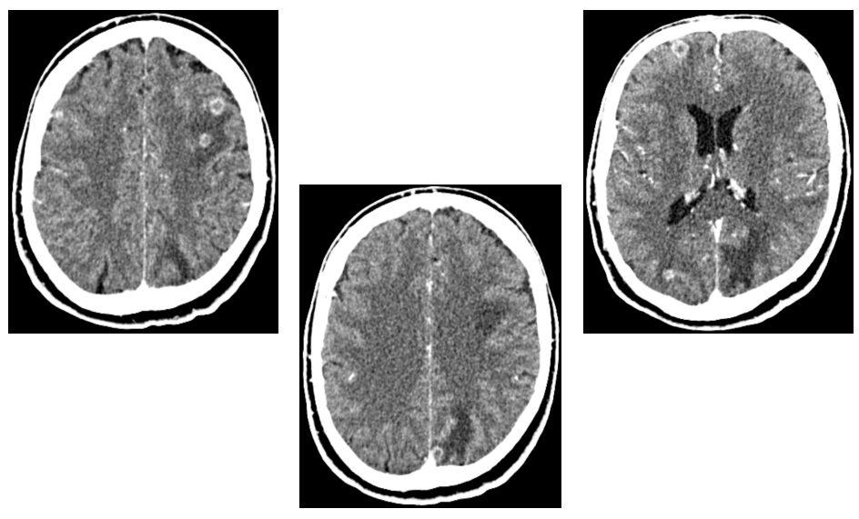 <p>What does this postcontrast CT image show?</p>