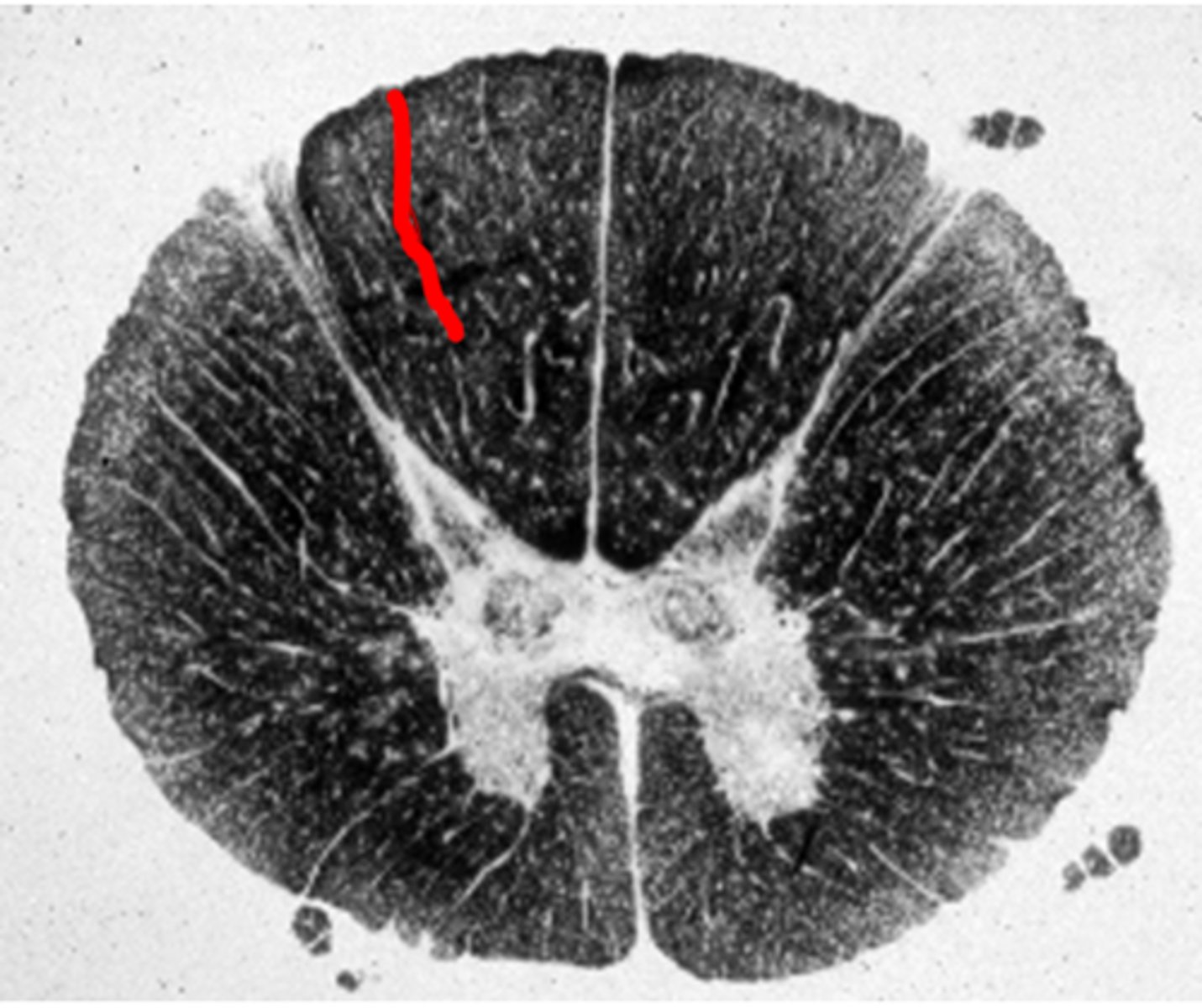 <p>Groove on the dorsal surface of the rostral part of the spinal cord, between the gracile and cuneate fasciculi, contains posterior spinal arteries</p>