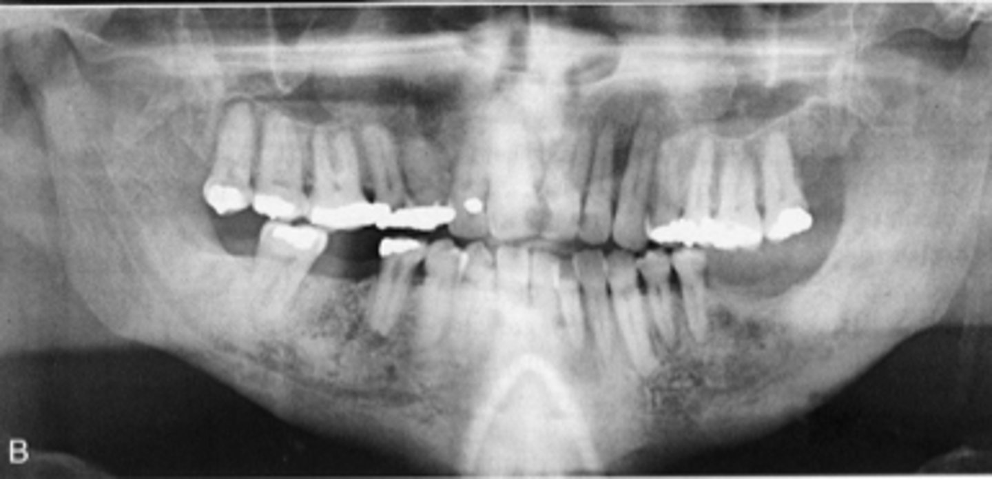 <p>describe the changes in bone density from this pano:</p>