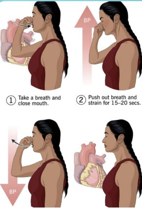 <p>Valsalva maneuver</p>