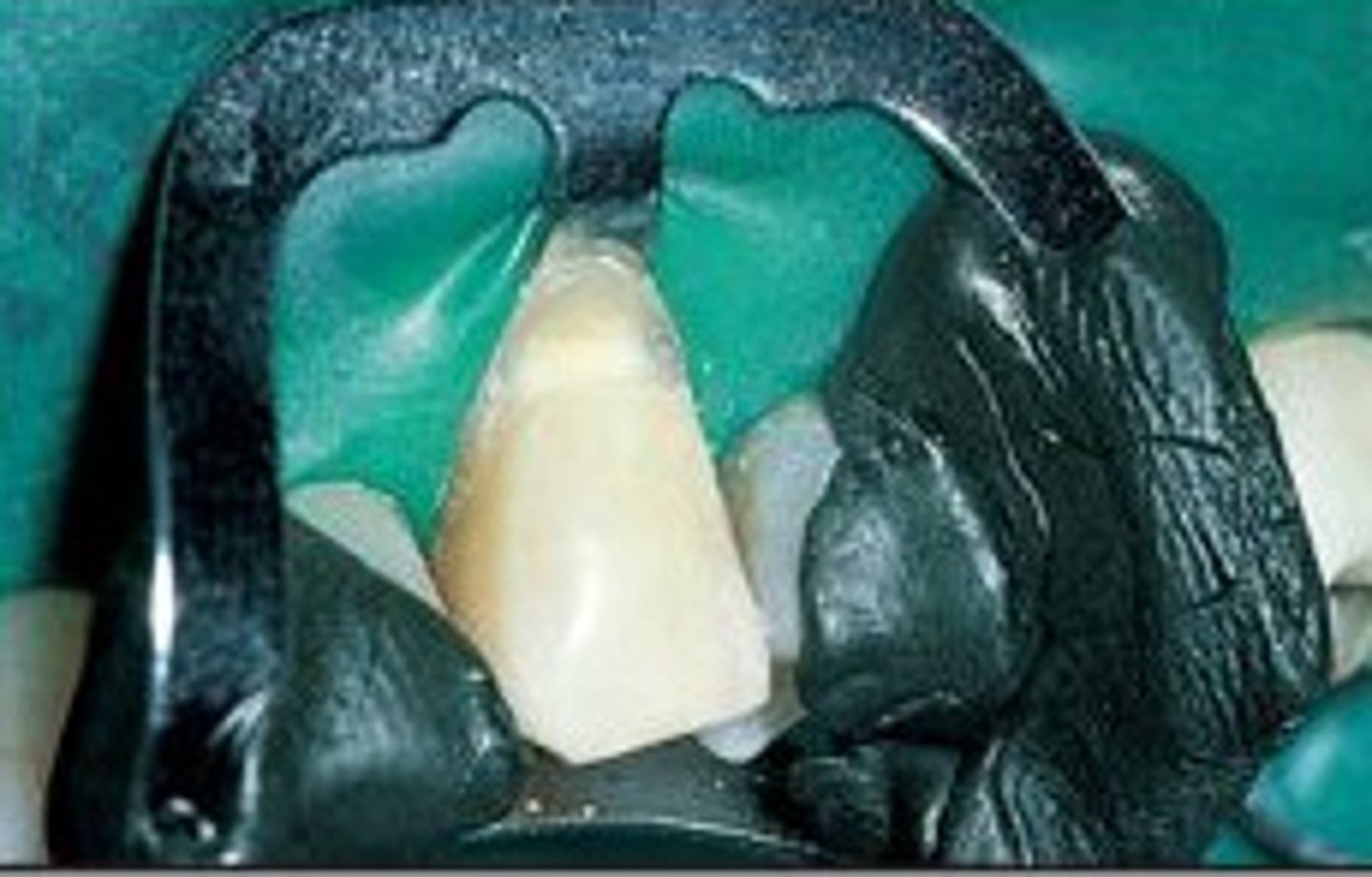<p>Double bowed, used for the anterior teeth.</p>