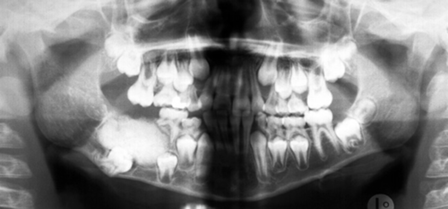 <p>Patient presents with well defined, corticated, radiolucent band that surrounds one large homogenous radiopacity, located on the posterior mandible. Cortical thinning and expansion, tooth impaction and root resorption is noted. What is the diagnosis?</p>