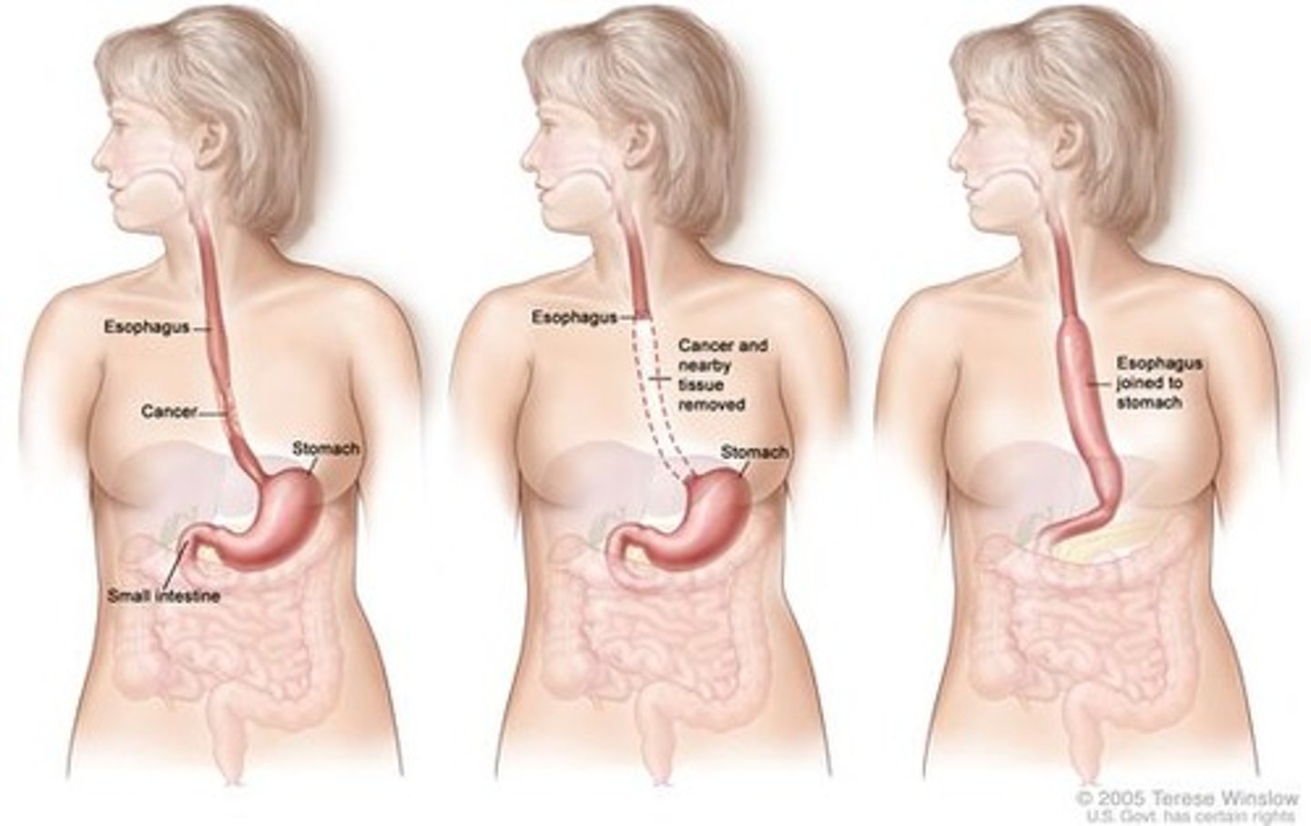 <p>remove all or part of the esophagus and replaced with a dacron graft</p>