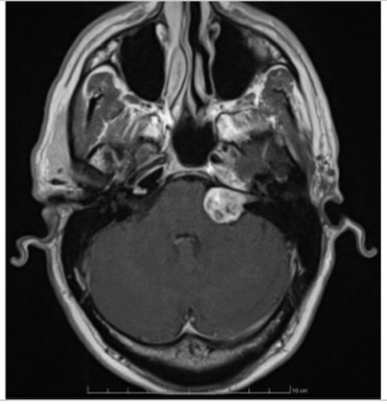 <p>What will a MRI in a vestibular schwannoma show?</p>