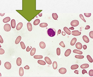 <ul><li><p>ovalcytes</p></li><li><p>normal in camelids &amp; nonmammals</p></li><li><p>associated with leukemia, hepatic dz, etc. </p></li></ul><p></p>