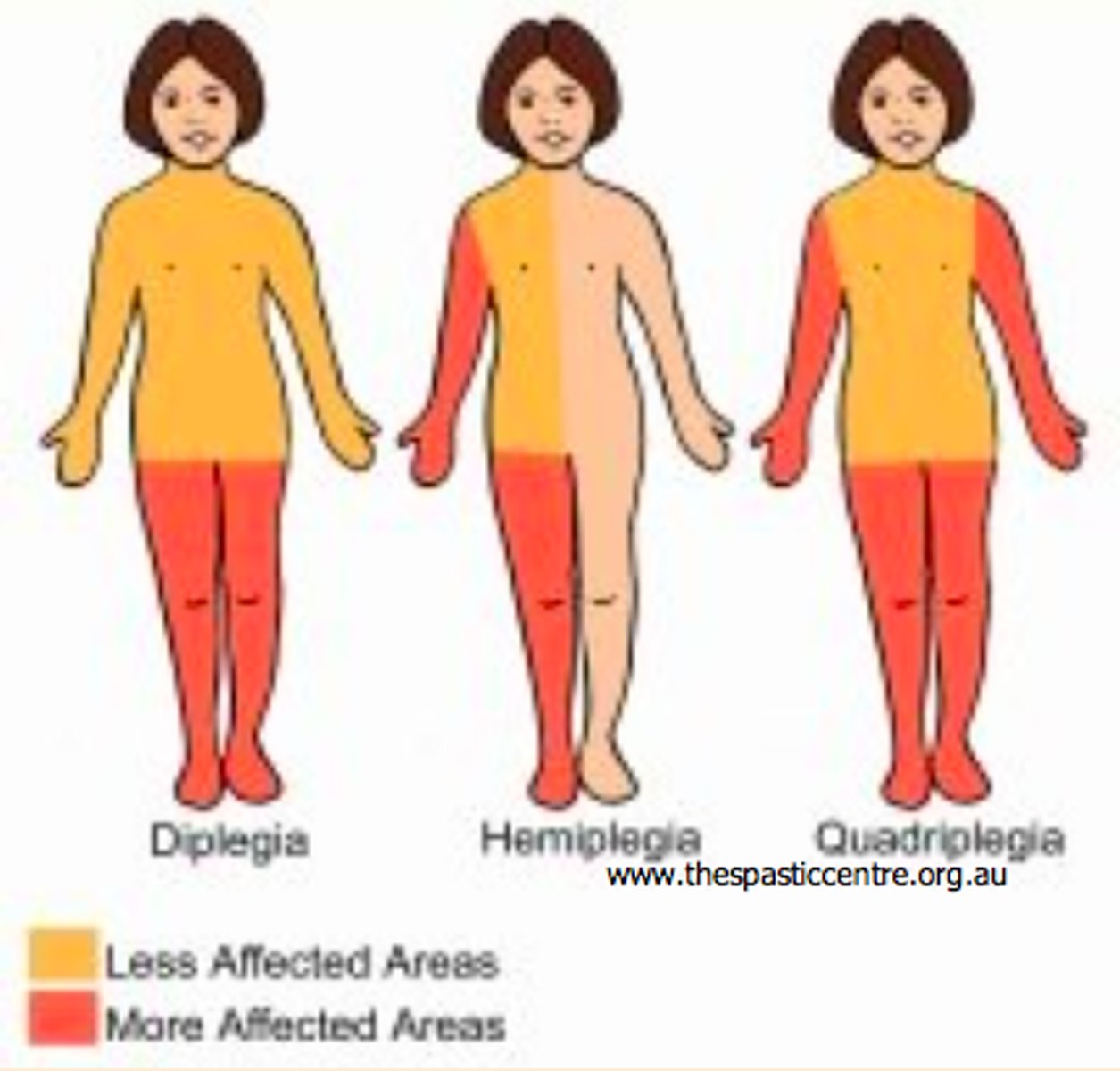 <p>Diplegia: two limbs</p><p>1 UE and 1 LE on same side: Hemiplegia</p><p>All 4 limbs: quadriplegia</p>