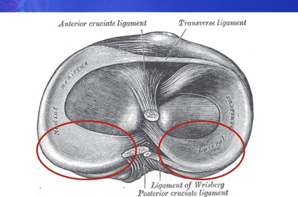 <ul><li><p>Meidal meniscus is less mobile and more often torn in ACL deficient knee</p><ul><li><p>Location of most tears: posterior horn of meniscus (red circles)</p></li></ul></li><li><p>MOI: tears occur when knee is flexed and rotated</p></li><li><p>Forces:</p><ul><li><p>Compression: condyles on plateau</p></li><li><p>Shear: AP displacement</p></li><li><p>Tensile: stretch out</p></li></ul></li><li><p>Tears include radial or oblique, longitudinal or cleavage plane (internal)</p><ul><li><p>Avulsion from root (spine)</p></li></ul></li><li><p>Healing &amp; repair:</p><ul><li><p>Outer 1/3 may repair itself w surgery</p></li><li><p>Hypovascular: no repair (degenerates)</p></li><li><p><strong>Meniscetomy</strong>: removes loose fragments, trimmed</p></li><li><p>Repair: sutured</p></li></ul></li><li><p>S/S: joint line tenderness: posterior horn region, slow effusion (delayed swelling) hypovascular, limited ROM, popping, clicking or locking sensation, narrowing of joint space: reduces funciton</p></li><li><p>Special Tests: Appley's Compression, McMurray's</p></li></ul><p></p>