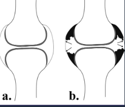 <ul><li><p>Papilomatous synovial hypertrophy</p></li><li><p>Panus</p></li><li><p>Cartilagee destruction</p></li><li><p>Bone destruction </p></li><li><p>Luxation / subluxation </p></li><li><p>Ankylosis</p></li><li><p>Inner organ disease</p></li></ul><p></p>