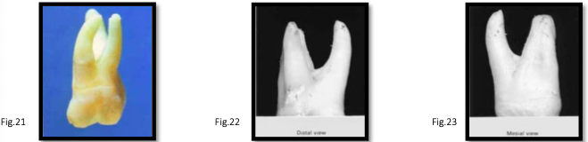 <p>canal anatomy of <strong>mx 1st molar</strong></p>