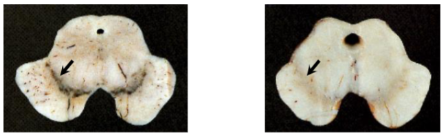 <p>Which one has Parkinson’s disease? Explain</p>