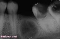 <p>Residual cyst</p>