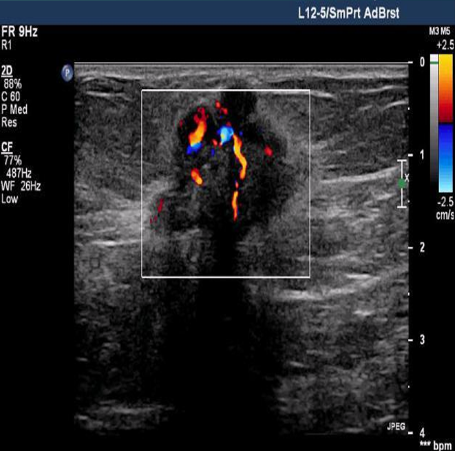 <p>highly suggestive of malignancy, tissue diagnosis (biopsy) </p>