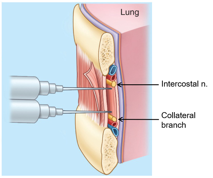 <p><strong>V.A.N. bundle</strong> consists of a <strong>Vein, Artery, and Nerve</strong>, which are arranged in the <strong>costal groove</strong> of each rib.</p>