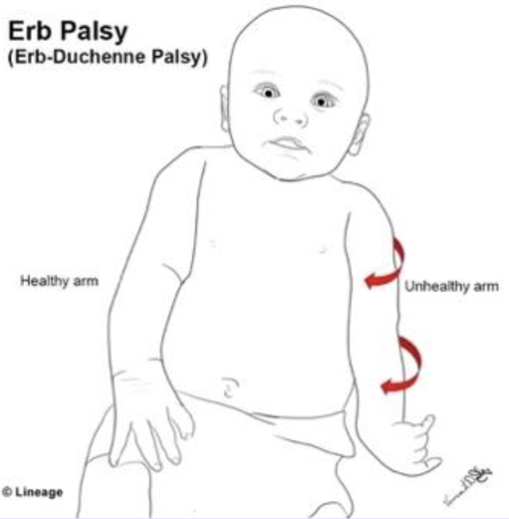 <p>Describe the Waiter’s tip deformity</p>