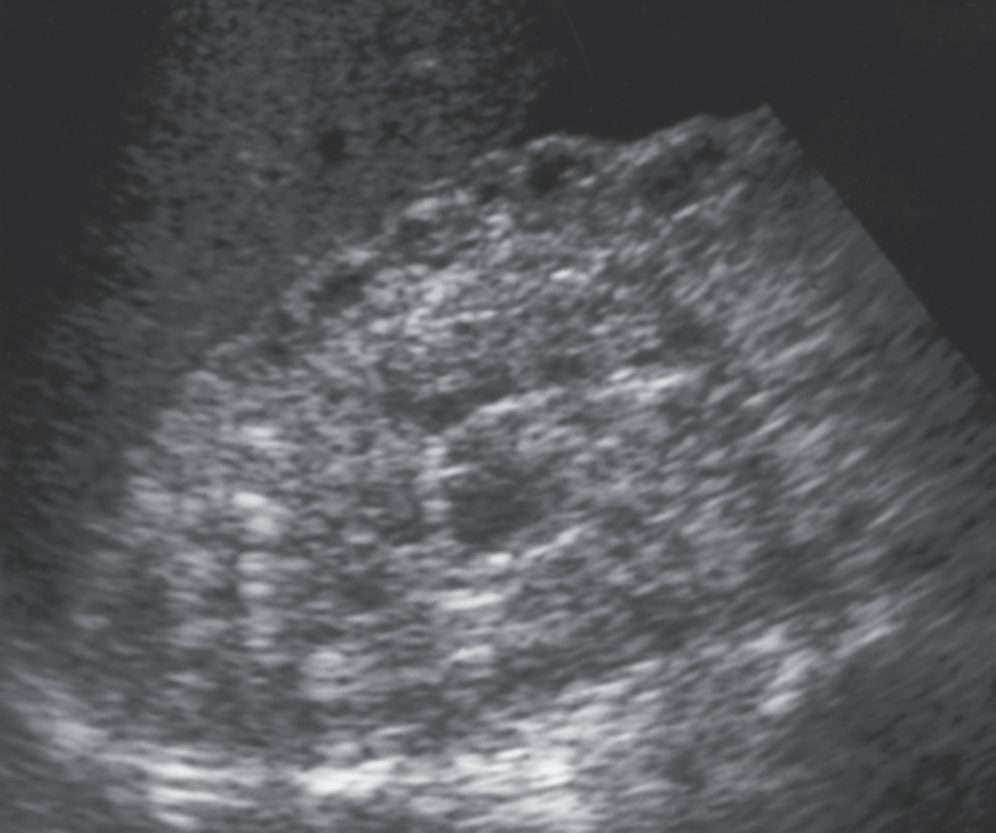 <p>a. Diabetes mellitus</p>