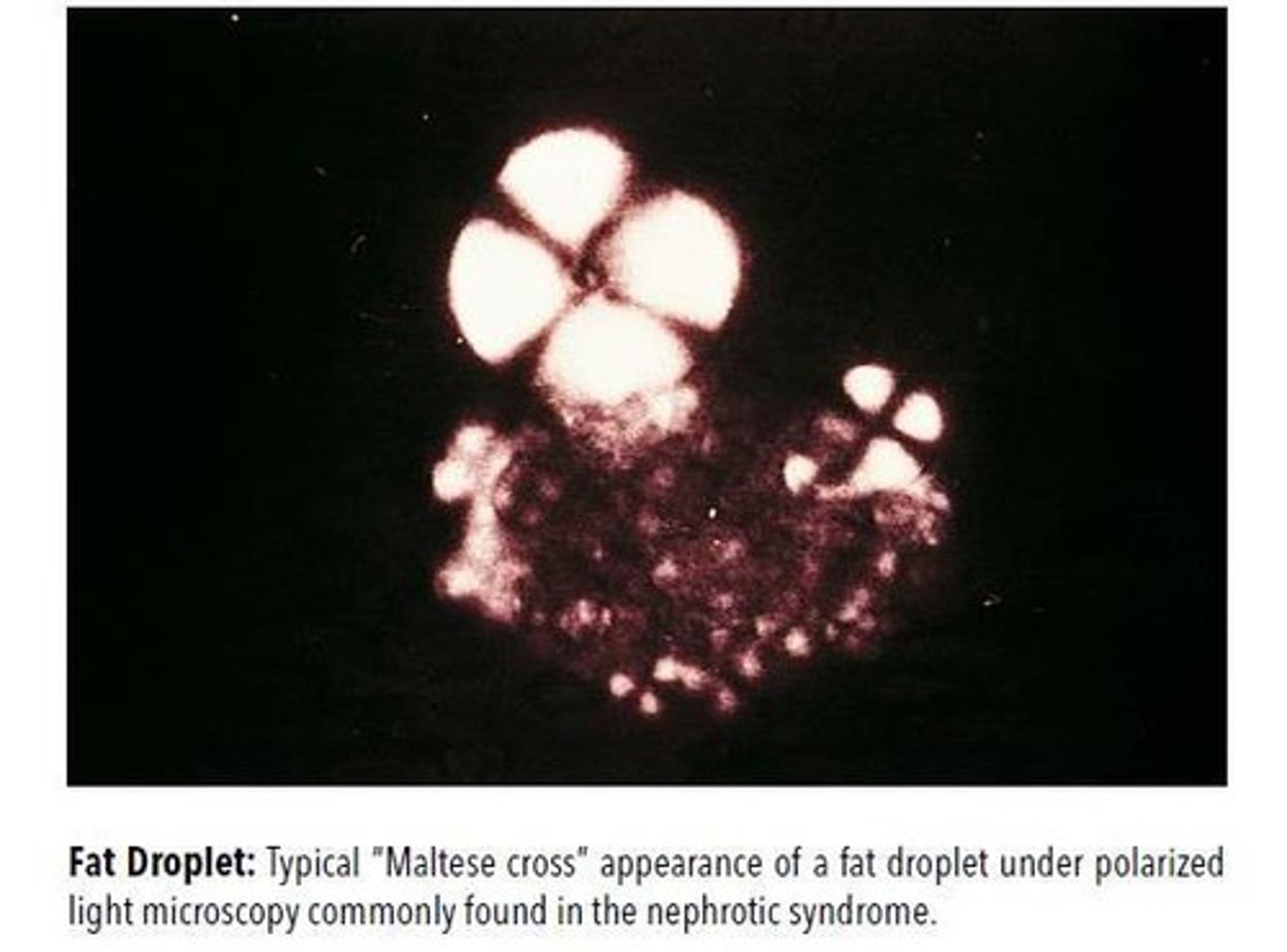 <p>Nephrotic Syndrome</p>