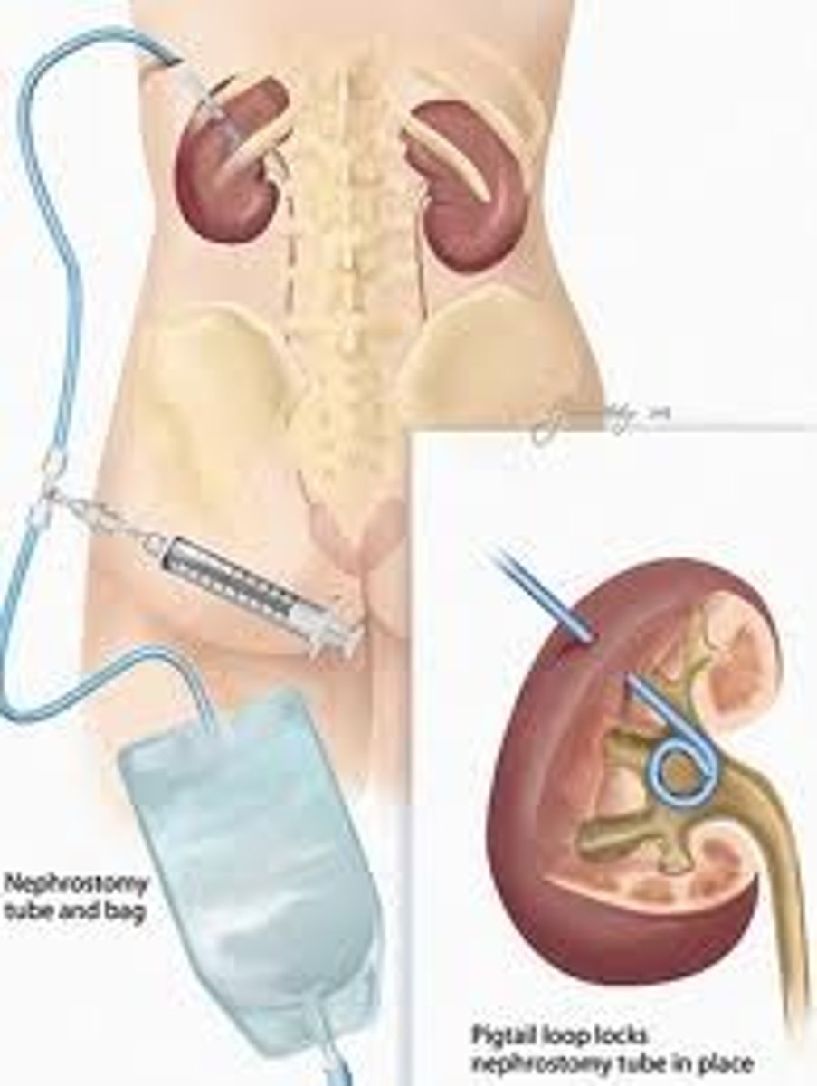 <p>a surgically created alternate route for urine flow</p><p>- nephrostomy means urine is diverted from kidney to a stoma</p>