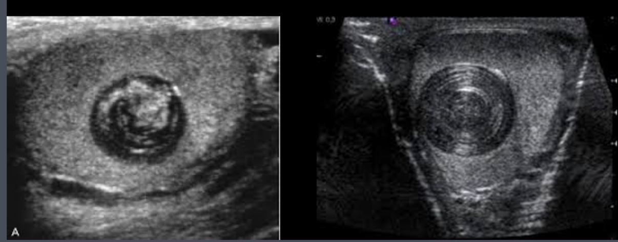 <p>What does the following describe?</p><p>•Benign tumor of germ cell origin</p><p>•Well-circumscribed solid tumor beneath tunica albuginea</p><p>•Sonographically – well definied, solid, hypoechoic with echogenic capsule or onion ring pattern formed by layered keratin</p><p>•“Bow-tie”/ “onion ring” appearance: central echogenic pattern</p>