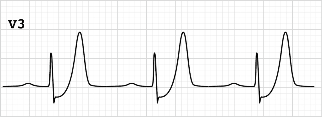<p>The de Winter pattern is seen in <strong>~2% of acute LAD occlusions </strong>and is often under-recognised by clinicians</p><p>Key diagnostic features include<strong> ST depression</strong> and <strong>peaked T waves</strong> in the <strong>precordial leads</strong></p><ul><li><p>Tall, prominent, symmetrical T waves in the precordial leads</p></li><li><p>Upsloping ST segment depression &gt; 1mm at the J point in the precordial leads</p></li><li><p>Absence of ST elevation in the precordial leads</p></li><li><p>Reciprocal ST segment elevation (0.5mm – 1mm) in aVR</p></li><li><p>Typical STEMI morphology may precede or follow the De Winter pattern</p></li></ul><p></p>