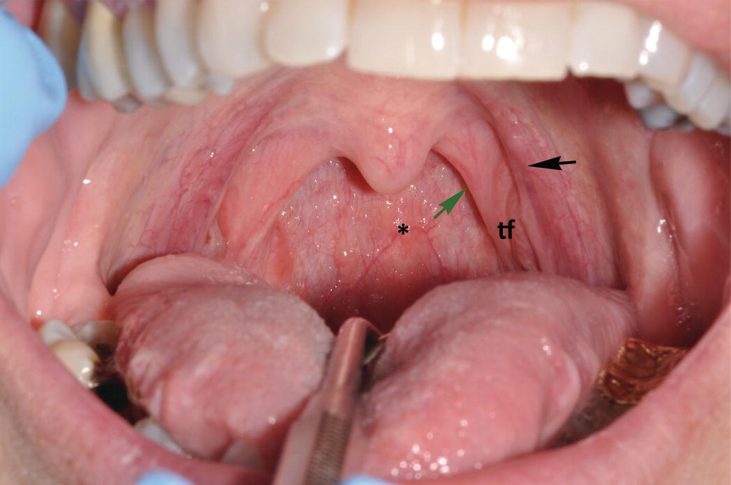 <p>Mucous membrane that covers the palatopharyngeus m. (green arrow)</p>