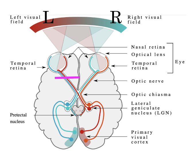 <p>What does the visual deficit (lesion) at the left optic nerve cause?</p>