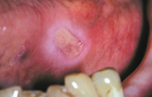 <p>usually heal in <span style="color: red;">1 or 2 weeks</span></p><p><span>a lesion characterized by</span><span style="color: red;"><span> focal loss of epithelium</span></span></p><p><span>result from a </span><span style="color: rgb(204, 0, 0);"><span>cut, abrasion, or irritation </span></span><span>of the mucosa</span></p>