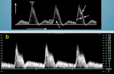 <p>Which of these 2 waveform images represents a waveform seen on a continuous wave doppler?&nbsp;</p>