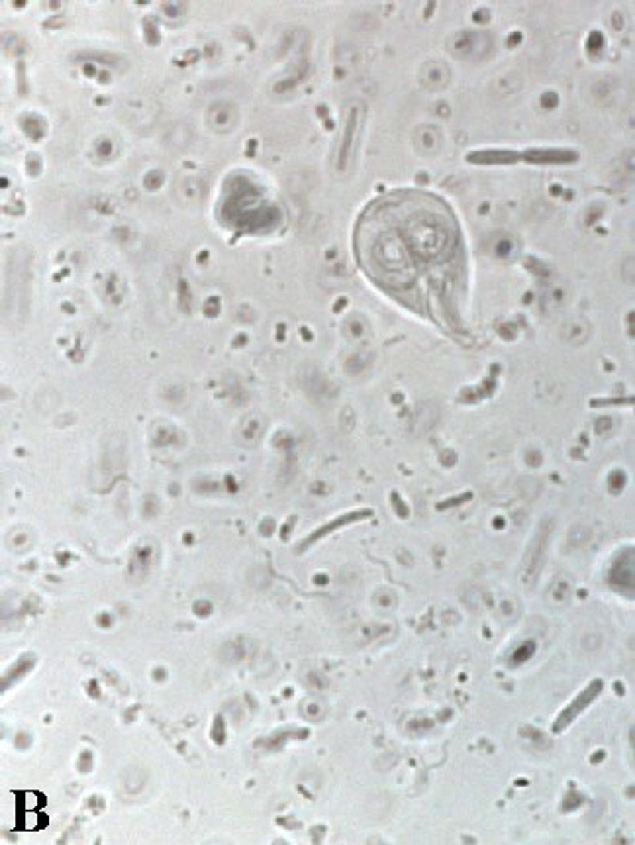 <p>recurrent diarrhea d/t protozoan</p>