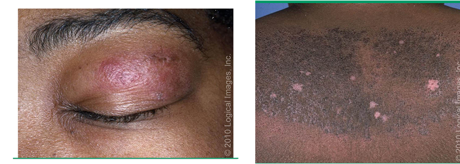 <p>idiopathic inflammatory myopathy that commonly presents w/ progressive, symmetric, proximal muscle weakness and a group of cutaneous findings</p><p>unknown cause</p>