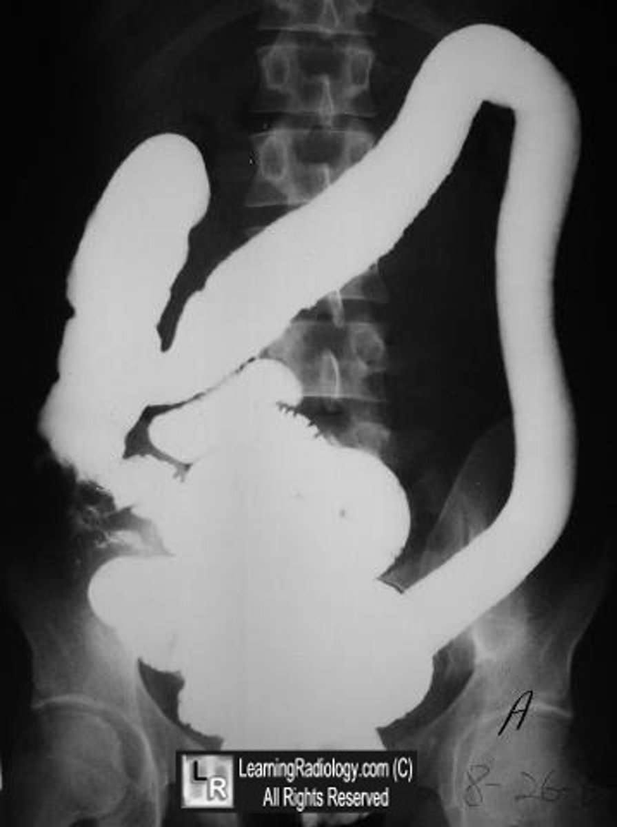 <p>Pseudopolyps, loss of haustra, and a resultant "lead pipe" appearance on imaging</p>