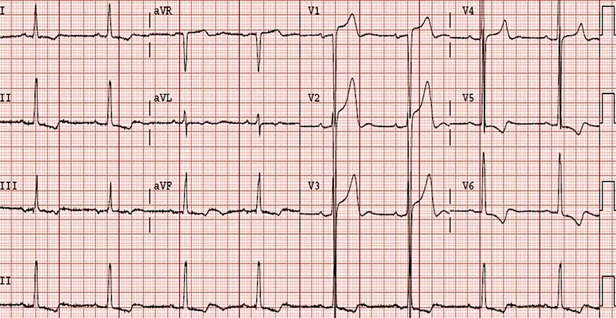 <p>LVH diagnosis</p>