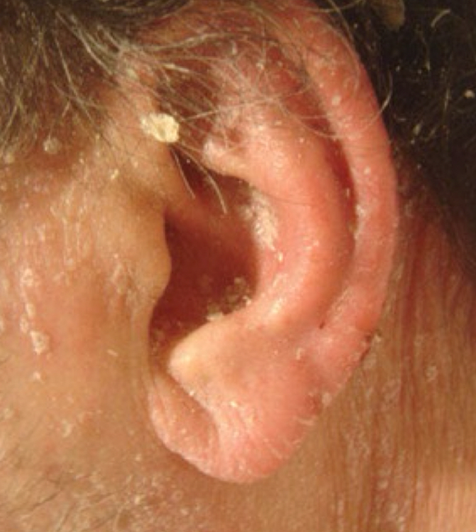 <p>what type of lesion and what condition is depicted</p>