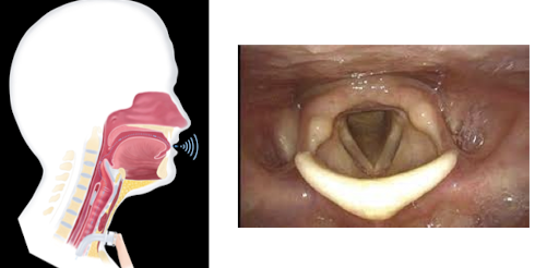 <p>At Minimum: finger occlusion (first step in eval)</p><p>Ideal Scenario: laryngoscopy (FEES)</p>