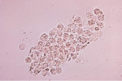 <p>-Collection of WBCs which leaked into renal tubules</p><p>-Typically occur in upper urinary tract infections (Pyelonephritis)</p>