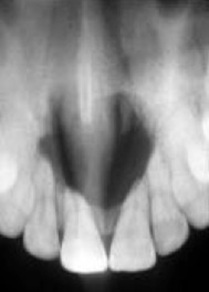 <p>developmental cyst within the nasopalatine canal</p><p>• also called Incisive Canal Cyst</p>