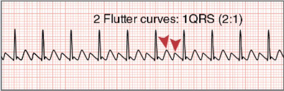 * atrial depolarization waves or "flutter" waves
* “saw tooth” appearance
* different ratios possible