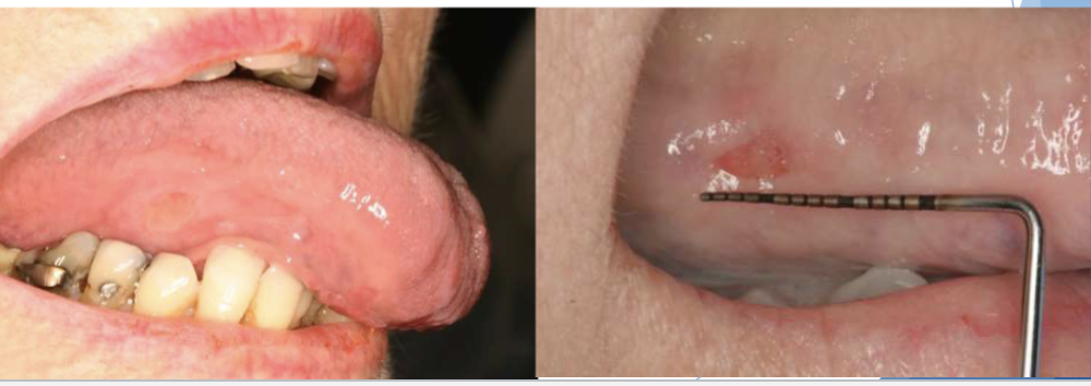 <p>traumatic ulcers </p>