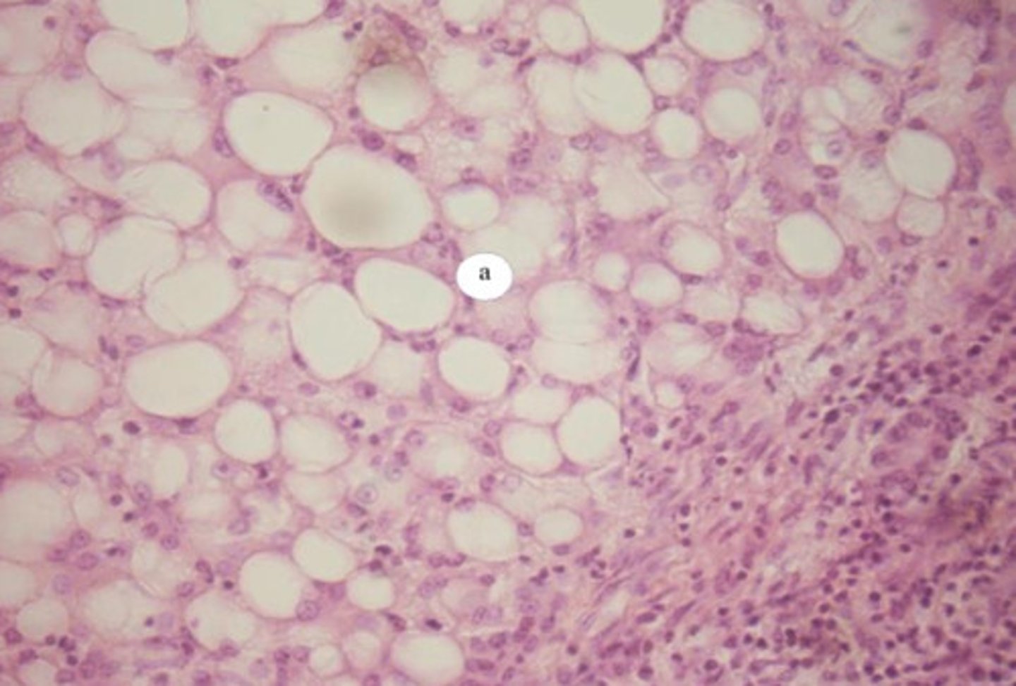 <p>lipids accumulate in liver (ex: during acute ethanol digestion)</p>