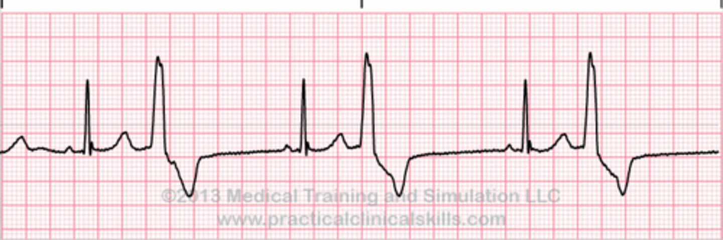 <p>nl QRS’s have p waves (sinus), every other beat is a PVC OR 2 back to back (bigeminy)</p>